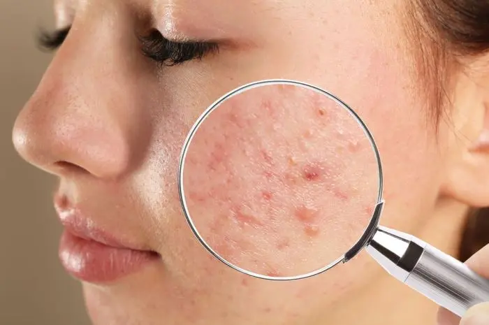 Ways to Get Rid of Acne Scars for Good